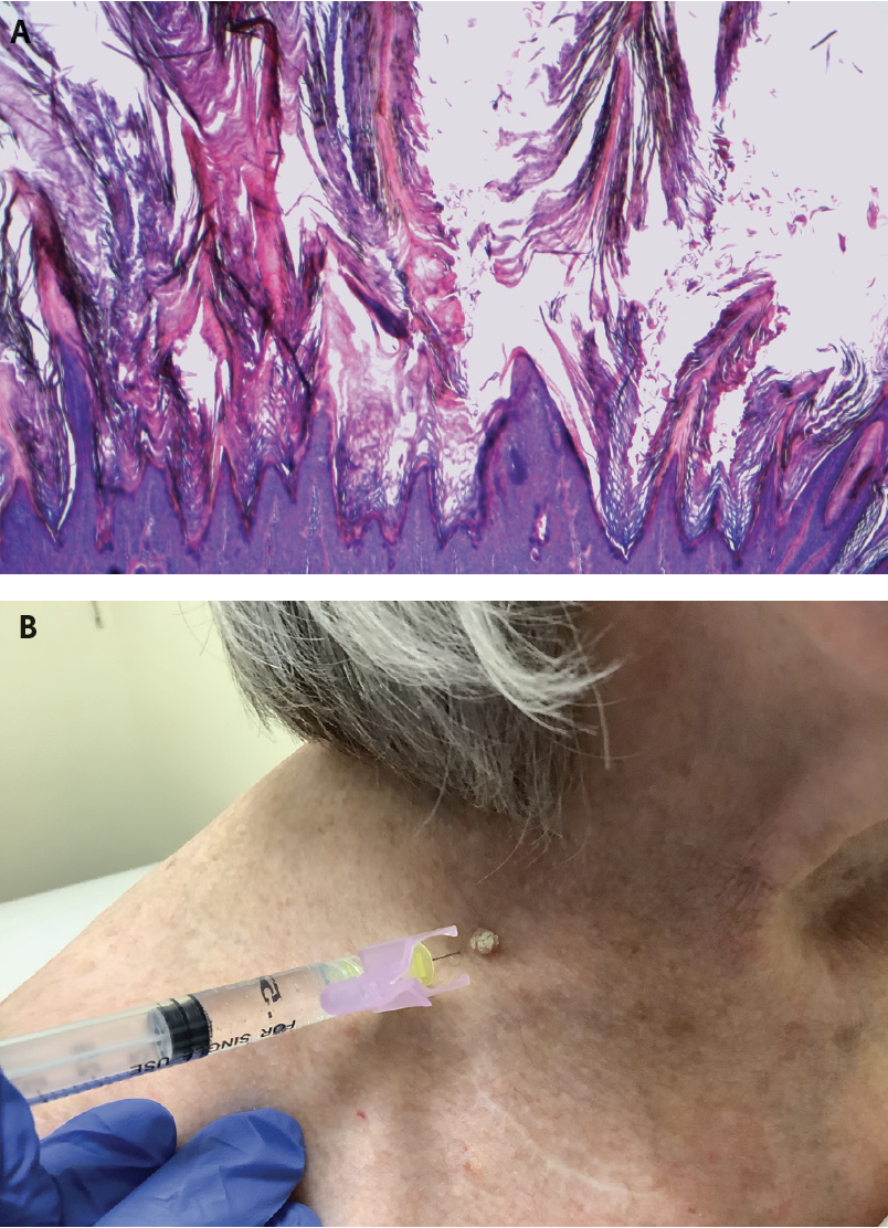 Seborrheic Keratosis The Most Common Reason Patients See Me